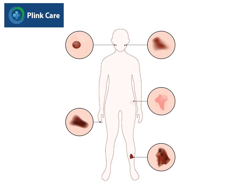 một số vị trí ung thư da phổ biến