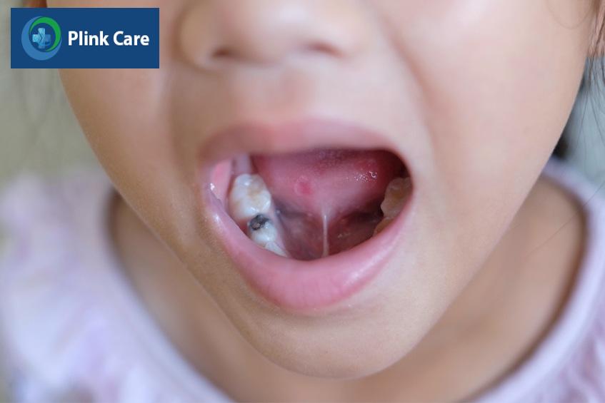 nên cắt thắng lưỡi cho trẻ