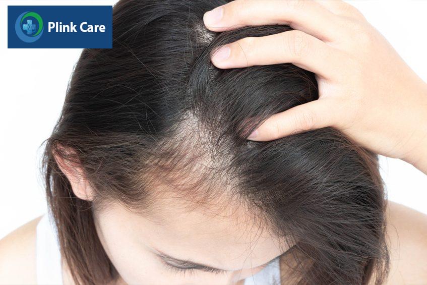Người bệnh suy giáp có các triệu chứng rụng tóc