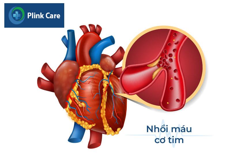 Nguy cơ nhồi máu cơ tim do hạ huyết áp