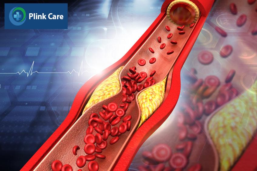 Nguy cơ xơ vữa động mạch nếu cholesterol trong máu tăng quá cao