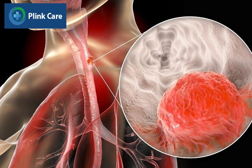 nguyên nhân gây hẹp thực quản