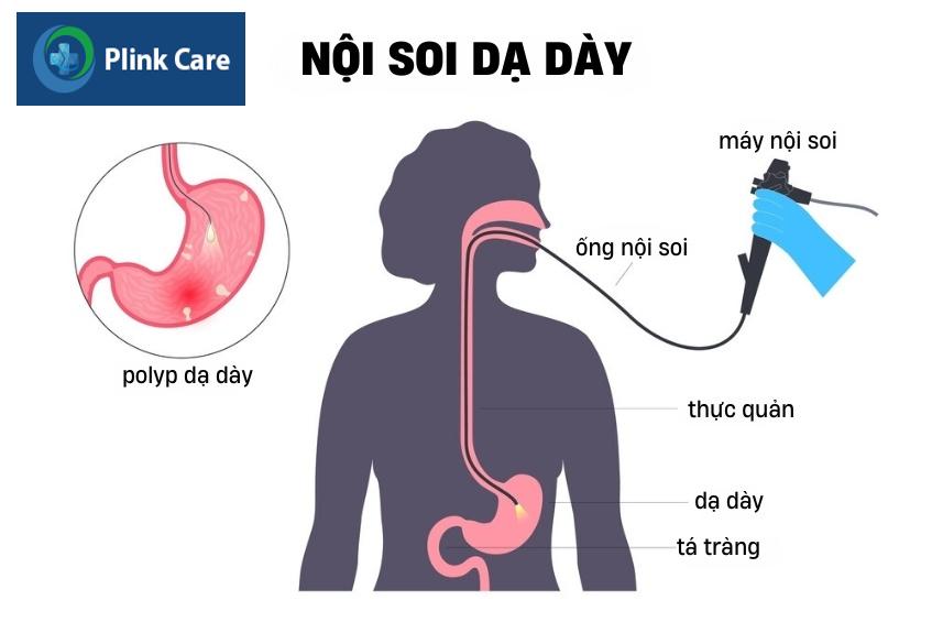 nội soi chẩn đoán giai đoạn 0 ung thư dạ dày
