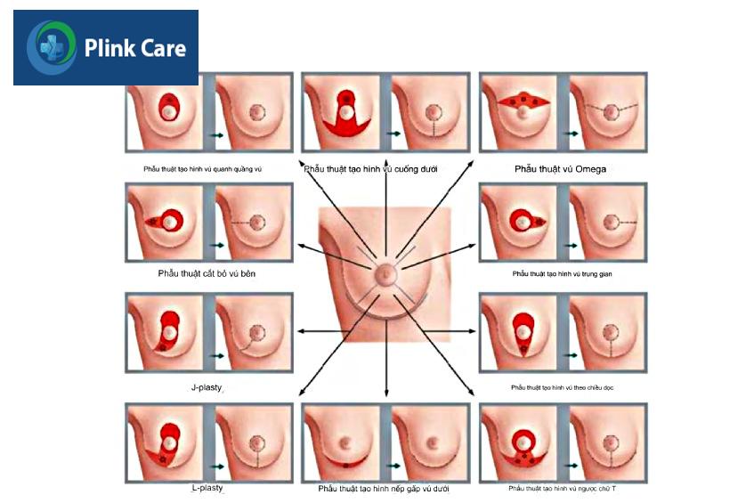 phẫu thuật bảo tồn vú OBCS