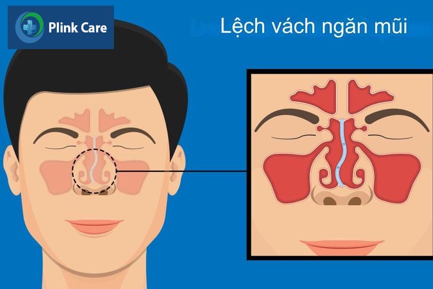 phẫu thuật chỉnh hình vách ngăn mũi