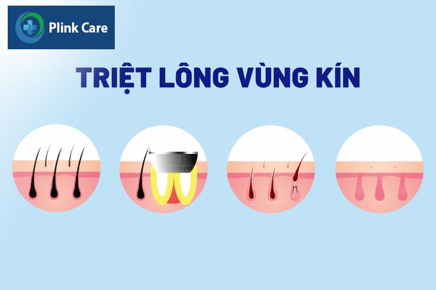 phương pháp triệt lông vùng kín