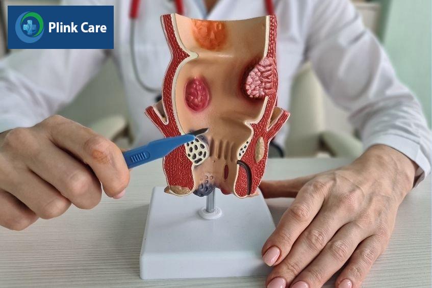 rò hậu môn có tự khỏi không