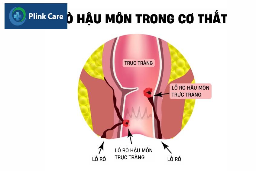 rò trong co thắt