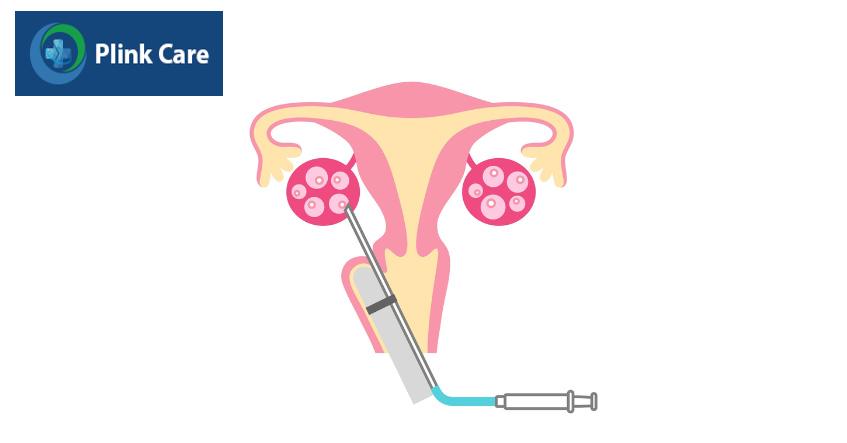 Sau khi xác định thời gian trứng rụng, bác sĩ tiến hành chọc hút noãn thực hiện IVF