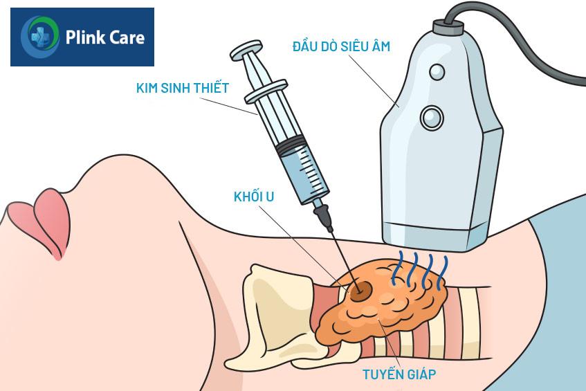 sinh thiết tuyến giáp
