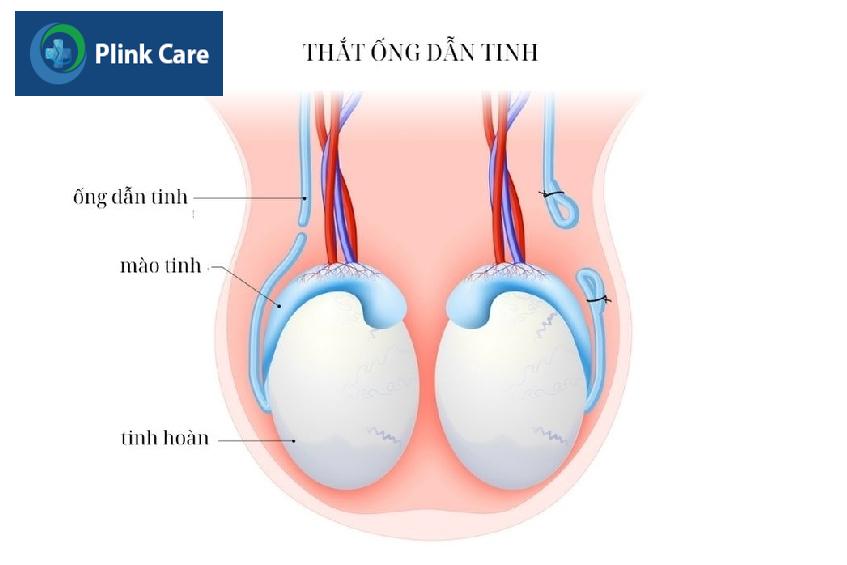 thắt ống dẫn tinh là gì