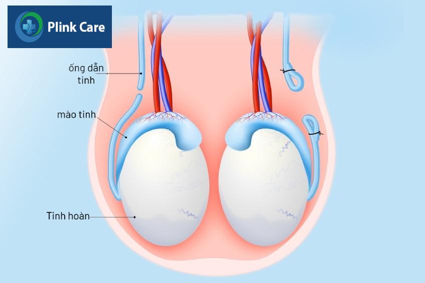 thắt ống dẫn tinh ở nam giới