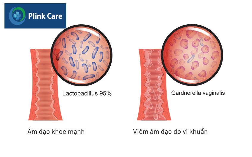 tình trạng nhiễm khuẩn âm đạo