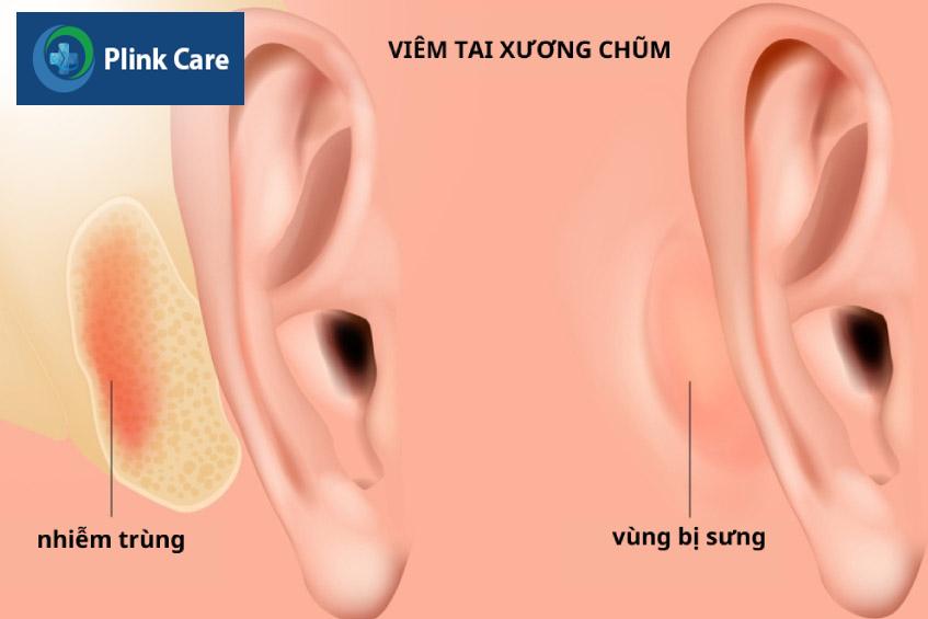 tình trạng viêm tai xương chủm