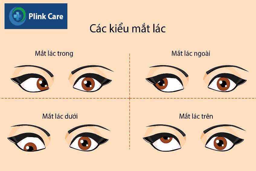 tổng quan về các kiểu mắt lác