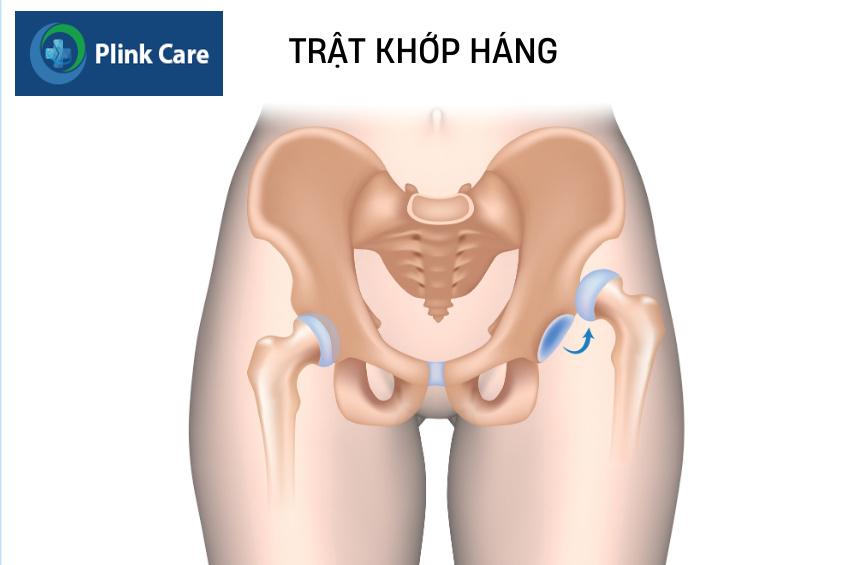trật khớp háng bao lâu thì khỏi phụ thuộc mức độ tổn thương