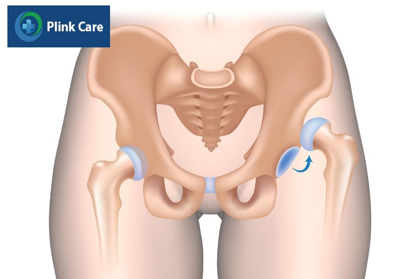 trật khớp háng làm mất khả năng vận động
