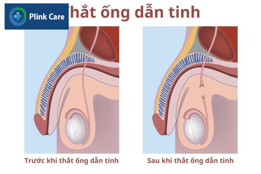 trước và sau khi thắt ống dẫn tinh