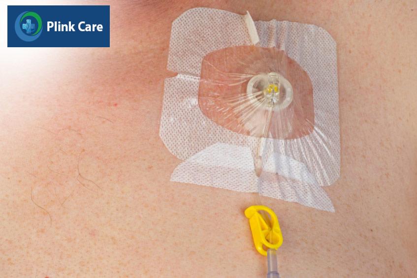 Truyền hóa chất thông qua buồng tiêm đặt dưới da