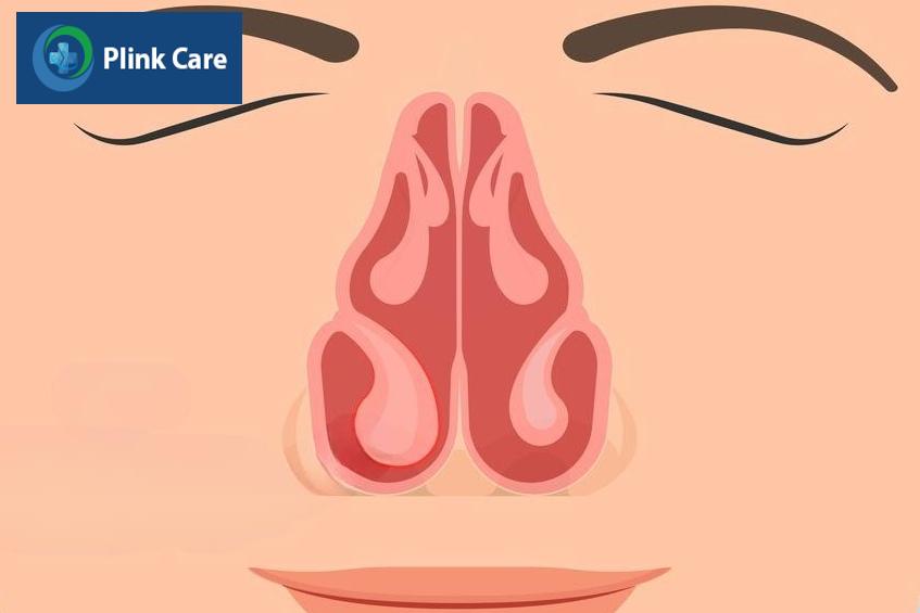 ai cần phẫu thuật chỉnh hình cuốn mũi