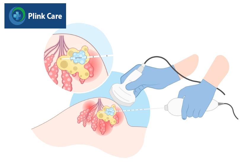 bệnh u xơ tuyến vú