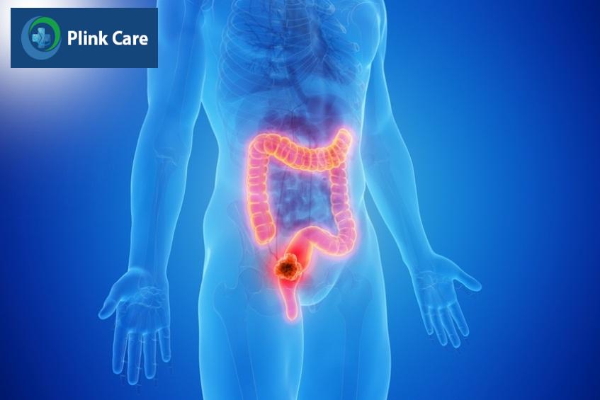 bệnh ung thư trực tràng cần phát hiện và điều trị sớm