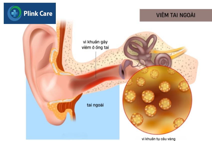 bệnh viêm ống tai ngoài