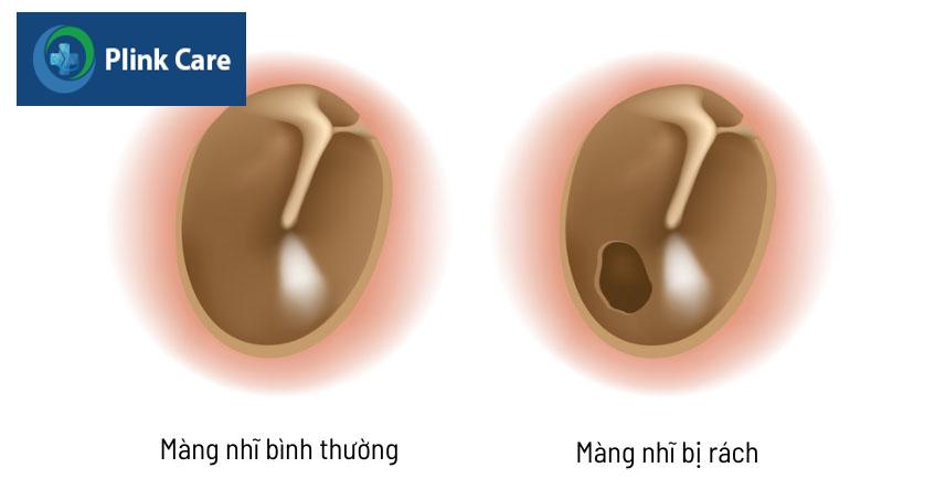 bị thủng màng nhĩ