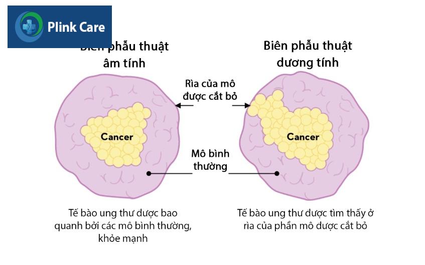 biên cắt phẫu thuật ung thư vú