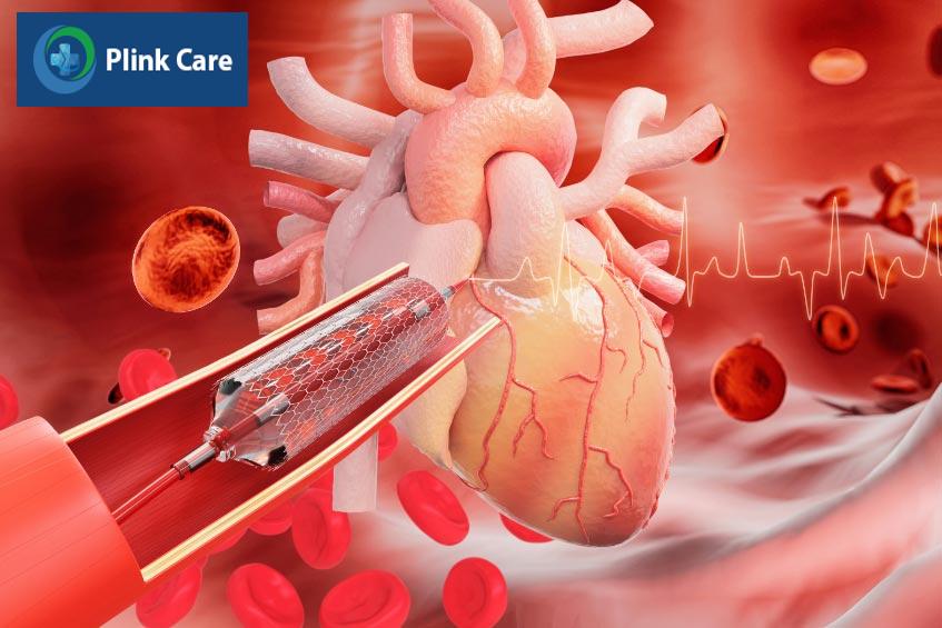 biến chứng huyết khối trong stent