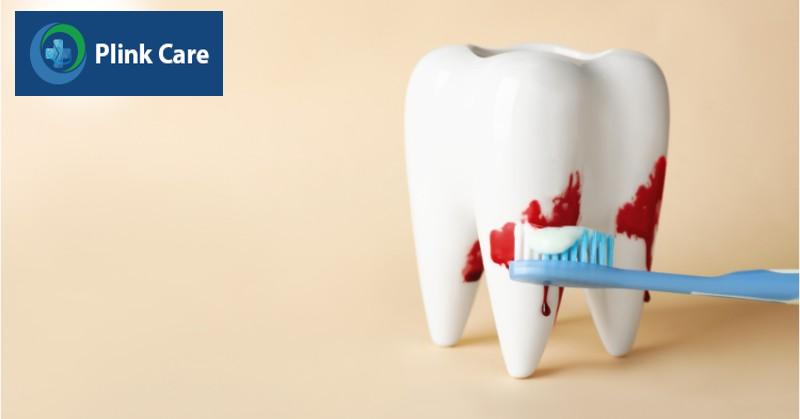 biến chứng nhổ răng khôn, chảy máu kéo dài