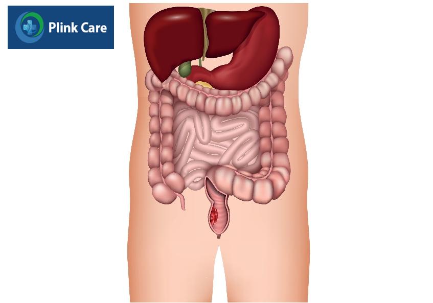 biểu hiện ung thư trực tràng trong hệ tiêu hóa