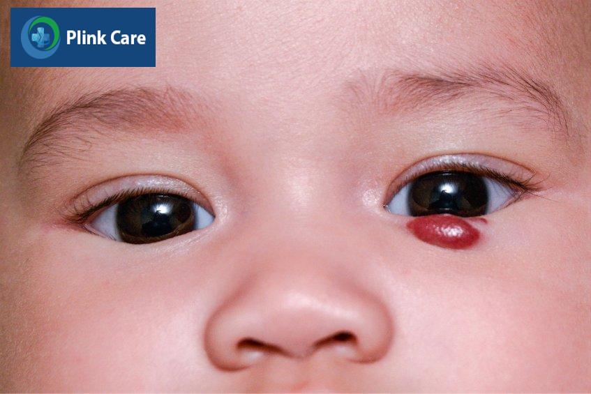 Bướu máu ở những vị trí ảnh hưởng đến thị lực