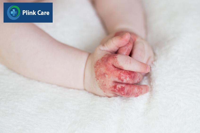 Bướu máu ở tay khi xuất hiện trên da