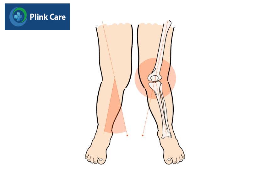 căn bệnh có thể tự khỏi khi trẻ lớn lên