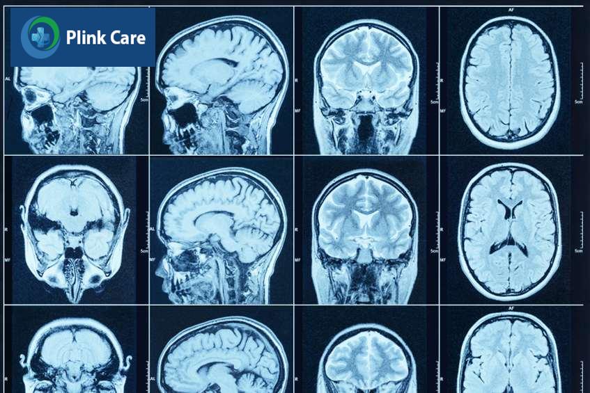 Chụp CT não cho ra hình ảnh sắc nét