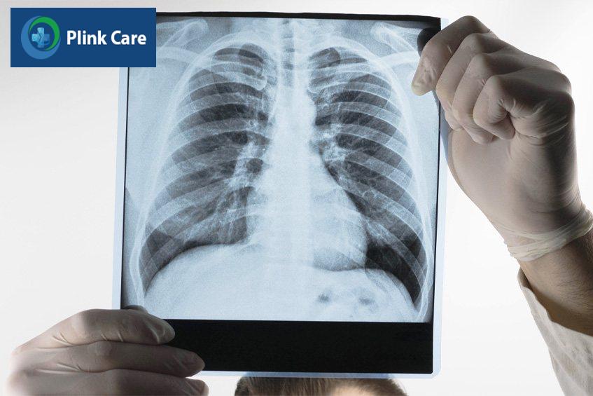 Chụp CT và X-quang ngực giúp đánh giá tổn thương phổi