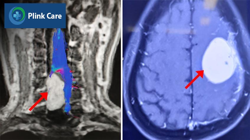 chụp mri trước phẫu thuật u xơ thần kinh