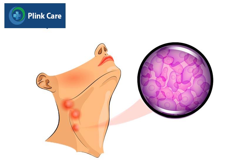 dấu hiệu đang mắc các loại u lympho da khá khác nhau