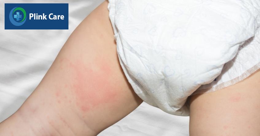 dấu hiệu nổi mề đay ở trẻ em