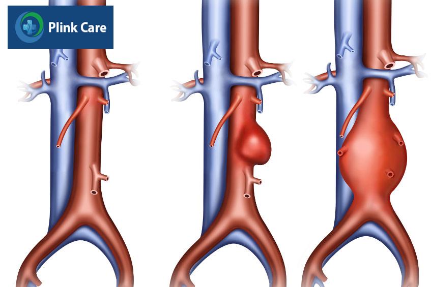 Động mạch bị yếu đi và phình ra tạo thành một khối chứa đầy máu