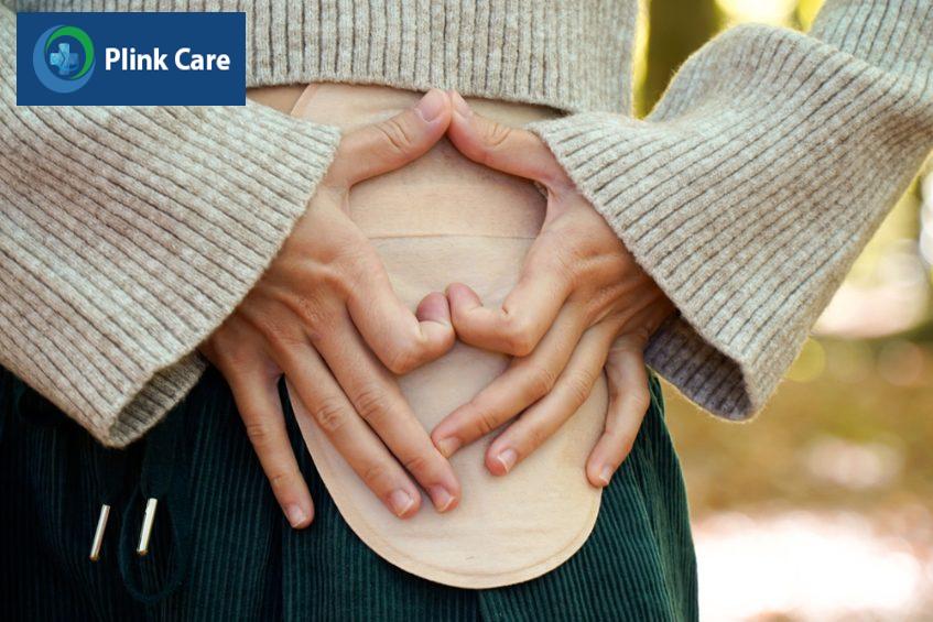 hậu môn nhân tạo điều trị ung thư trực tràng giai đoạn 4
