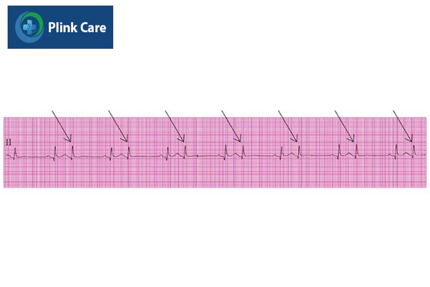 Hình ảnh ngoại tâm thu nhĩ trên ECG (Nguồn từ nghiên cứu của PGS. TS Phạm Nguyễn Vinh, 2019 Ngoại Tâm Thu)