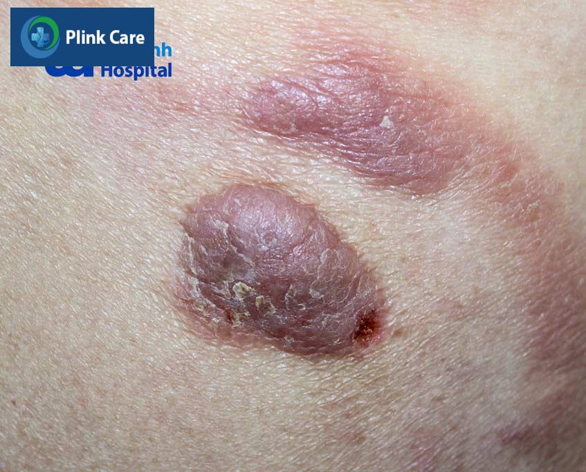 hình ảnh thực tế của mycosis fungoides