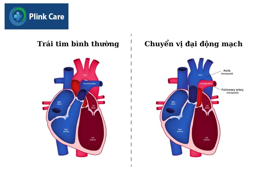 Hình ảnh trái tim bình thường và trái tim bị chuyển vị đại động mạch