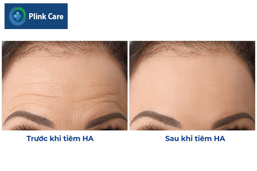 hình ảnh trước và sau khi tiêm ha