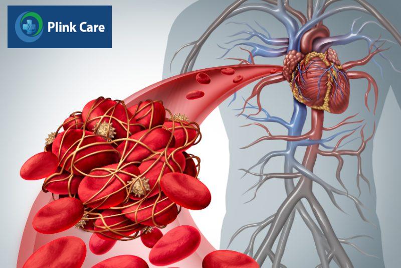 Hình thành cục máu đông ở bệnh nhân bị cơ tim phì đại