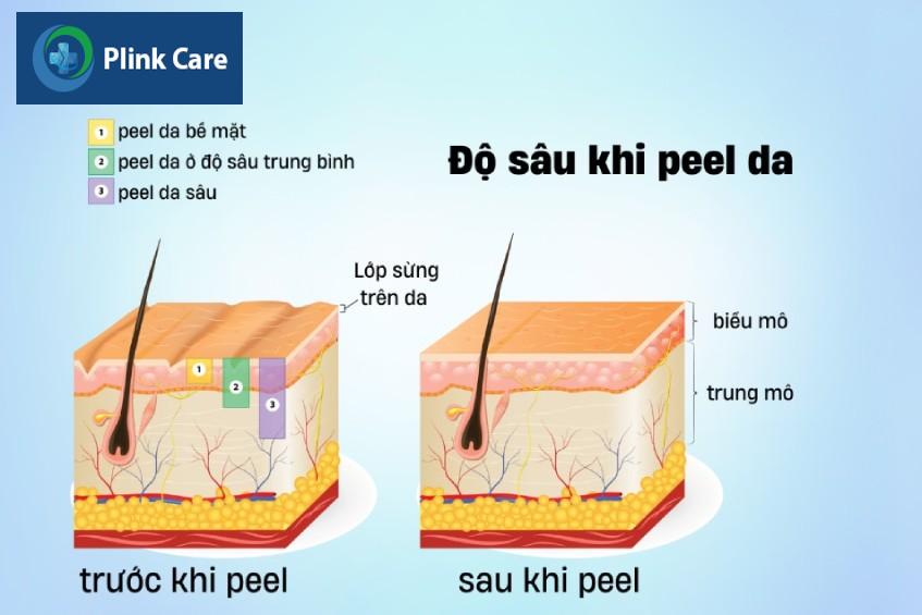 khi nào nên peel da body