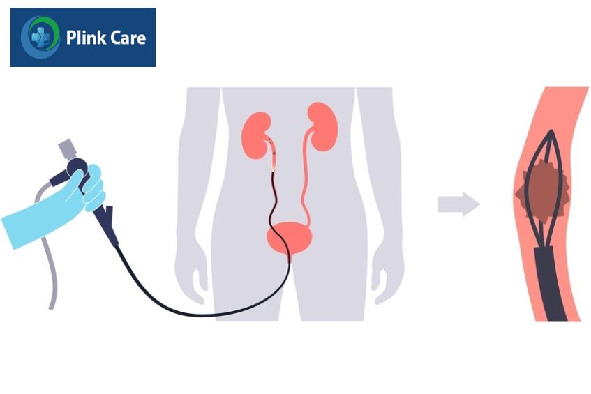 lấy mảnh sỏi trong niệu quản qua ống nội soi