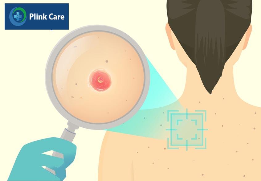 lymphomatoid papulosis thường giống mụn nhọt lớn